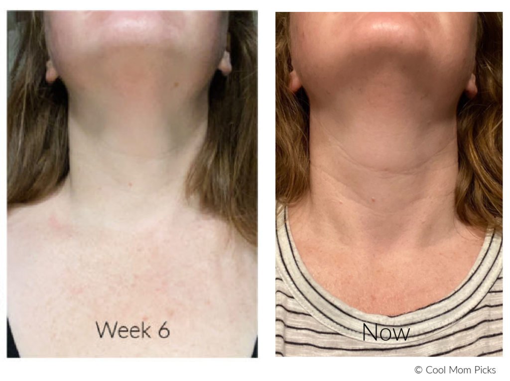 DefensAge Neck Cream results: 8 weeks after stopping the routine | More details: cool mom picks
