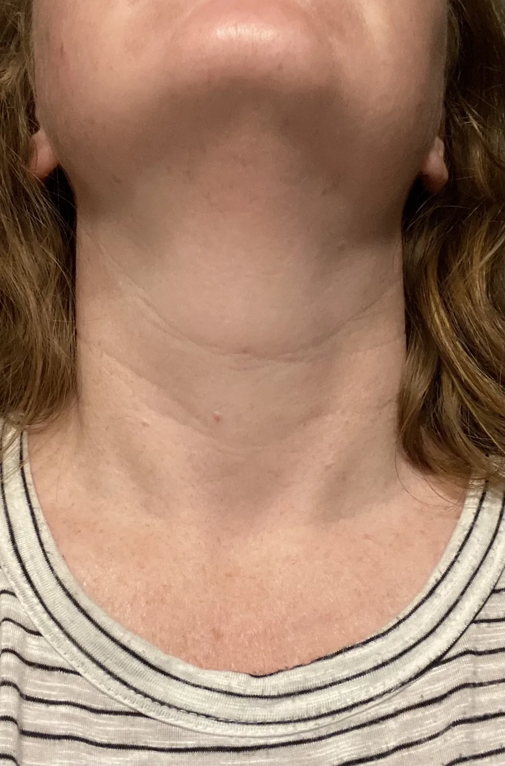 Our editor's results with DefenAge 6-week Perfection Neck Cream.
